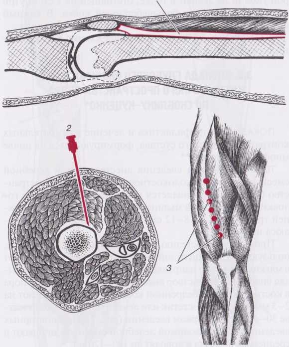 3.5. БЛОКАДА ГЛУБОКОГО 0К0Л0К0СТН0Г0 КЛЕТЧАТ0ЧН0Г0 ПРОСТРАНСТВА БЕДРА ПО СКОБЛИНУ-КУЦЕНКО 3.5. БЛОКАДА ГЛУБОКОГО 0К0Л0К0СТН0Г0 КЛЕТЧАТ0ЧН0Г0 ПРОСТРАНСТВА БЕДРА ПО СКОБЛИНУ-КУЦЕНКО